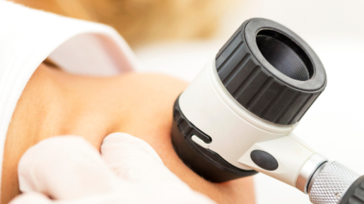 image of skin cancer check